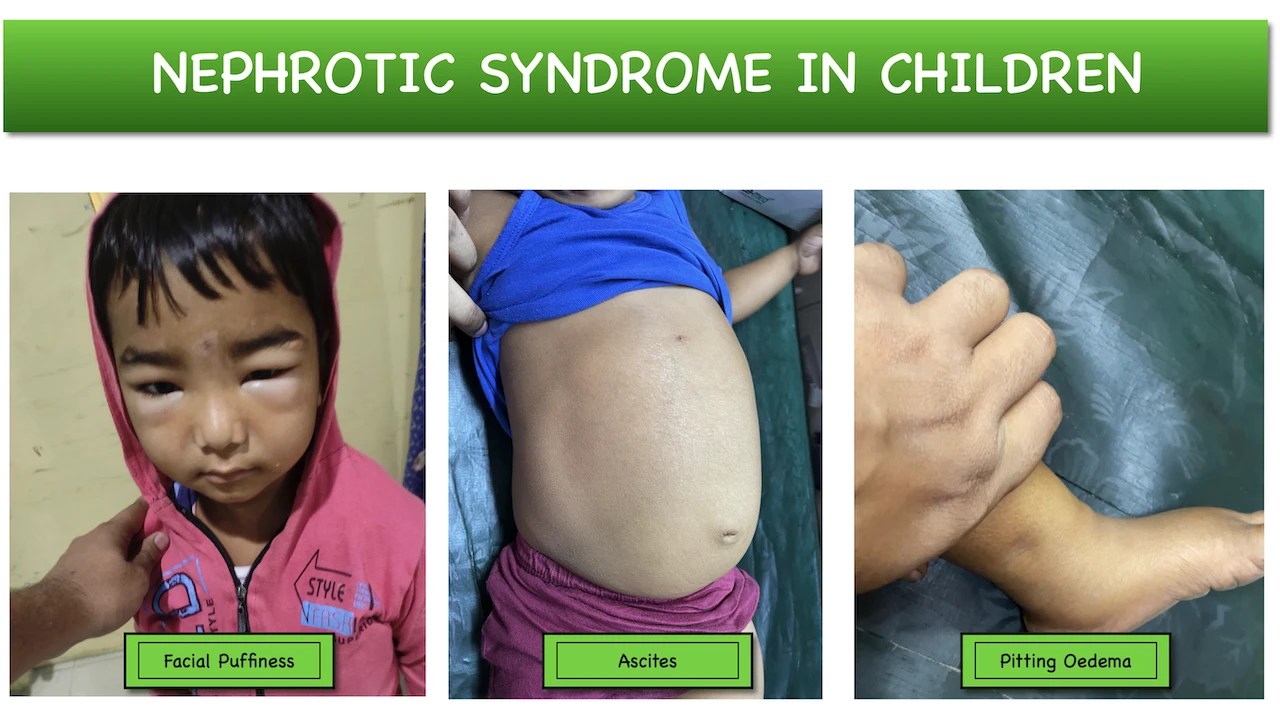Nephrotic Syndrome in children Causes Clinical features